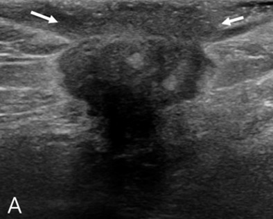Male breast cancer presenting in accessory axillary breast