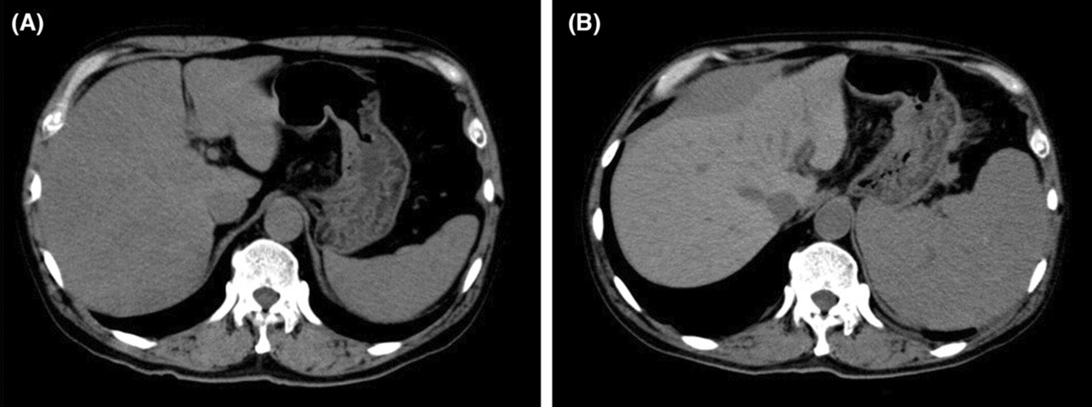Aggressive diffuse large B-cell lymphoma manifested by splenic rupture progressed 2 months after transverse myelitis: an autopsy case report