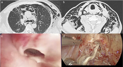 Multi-organs perioperative immune-related adverse events and postoperative bronchial anastomotic fistula in a patient receiving neoadjuvant immunotherapy with NSCLC