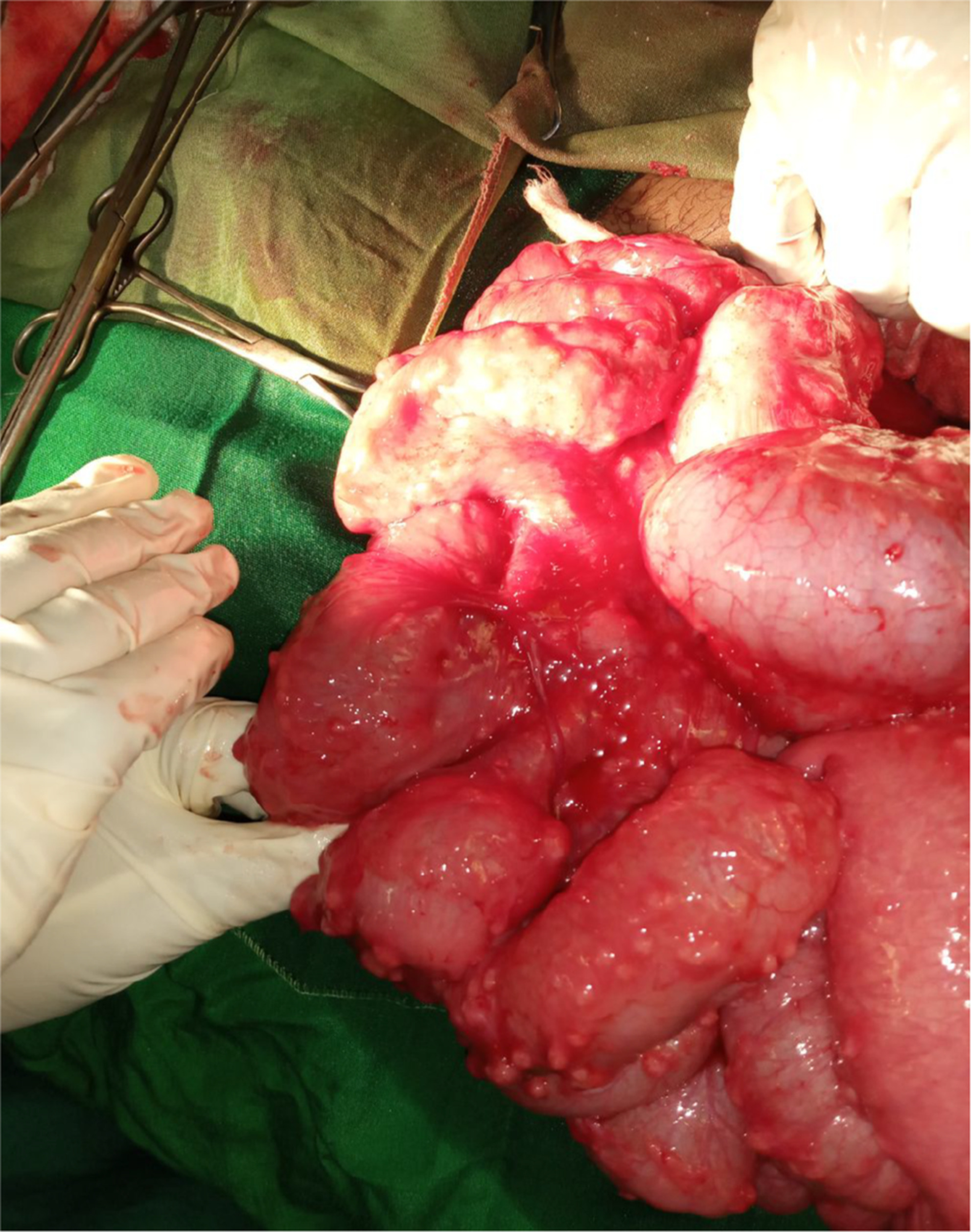 Intestinal tuberculosis—the challenging mimicker—in a young Sudanese patient: A case report