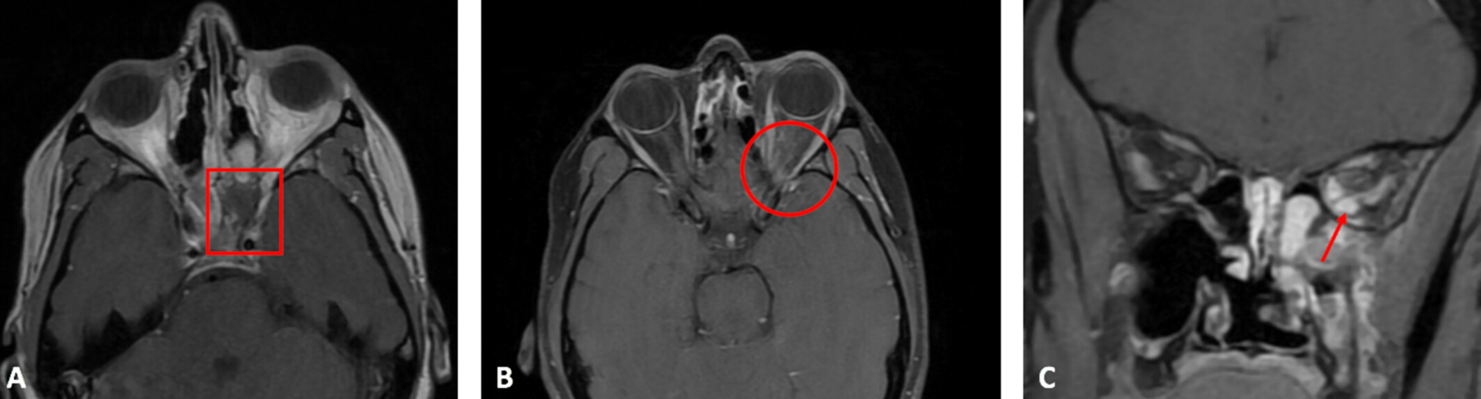 Invasive Fungal Sinusitis in an Immunocompetent Patient After Sinus Surgery for Chronic Rhinosinusitis with Nasal Polyps and a Mycetoma