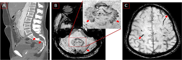 A superficial siderosis-related transient focal neurological episode in a patient with Marfan syndrome