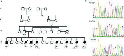 Homozygosity for FARSB mutation leads to Phe-tRNA synthetase-related disease of growth restriction, brain calcification, and interstitial lung disease