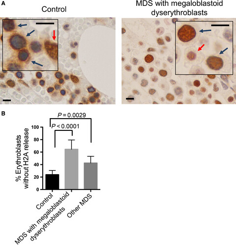 Disruption of erythroid nuclear opening and histone release in myelodysplastic syndromes