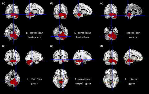 Voxel-based meta-analysis of gray and white matter volume abnormalities in spinocerebellar ataxia type 2