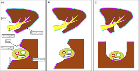Glissonean approach for hepatic inflow control in minimally invasive anatomic liver resection: A systematic review