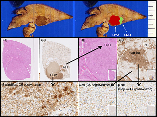 Hepatocellular nodules resulting from congenital extrahepatic portosystemic shunts can differentiate into potentially malignant hepatocellular adenomas