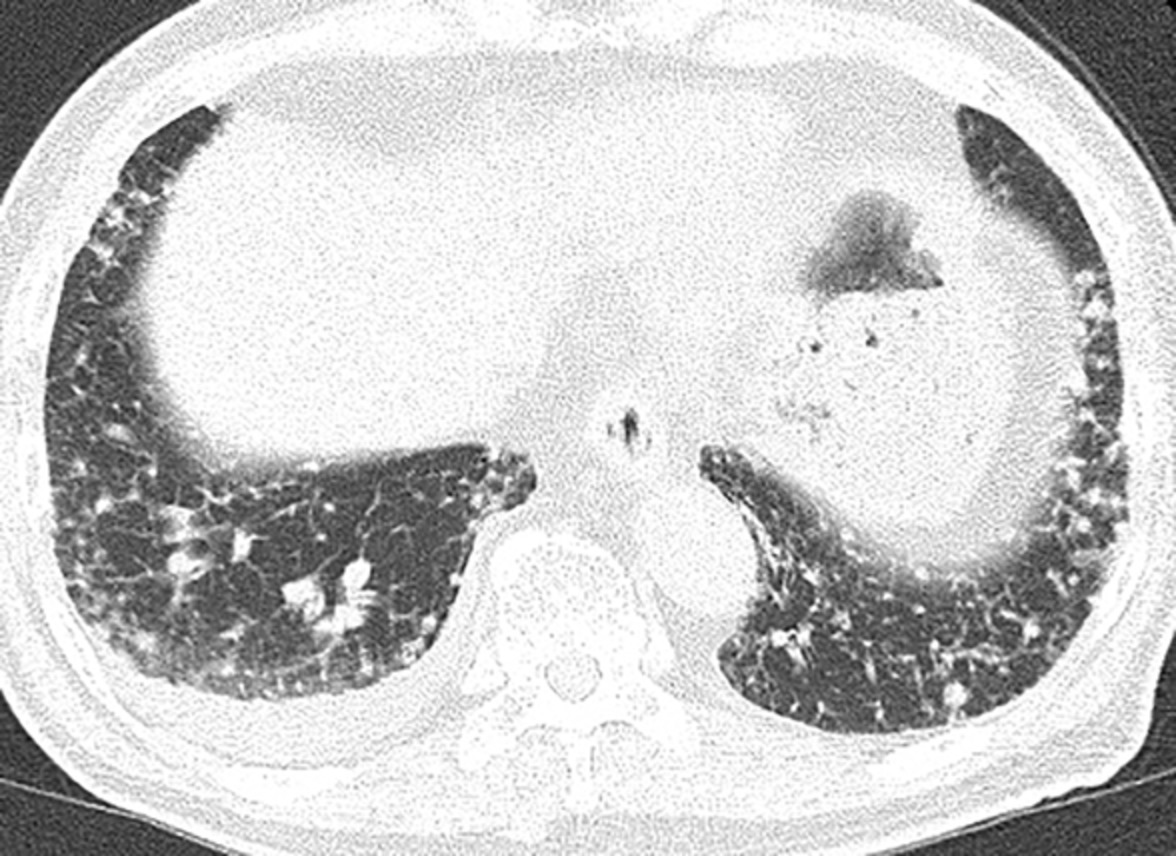 Unusual lung involvements of invasive mucinous adenocarcinoma with chylothorax