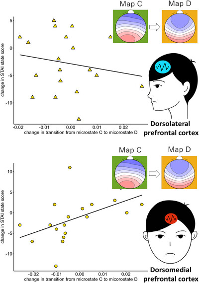 A Single Session of tDCS Stimulation Can Modulate an EEG Microstate Associated With Anxiety in Patients With Depression