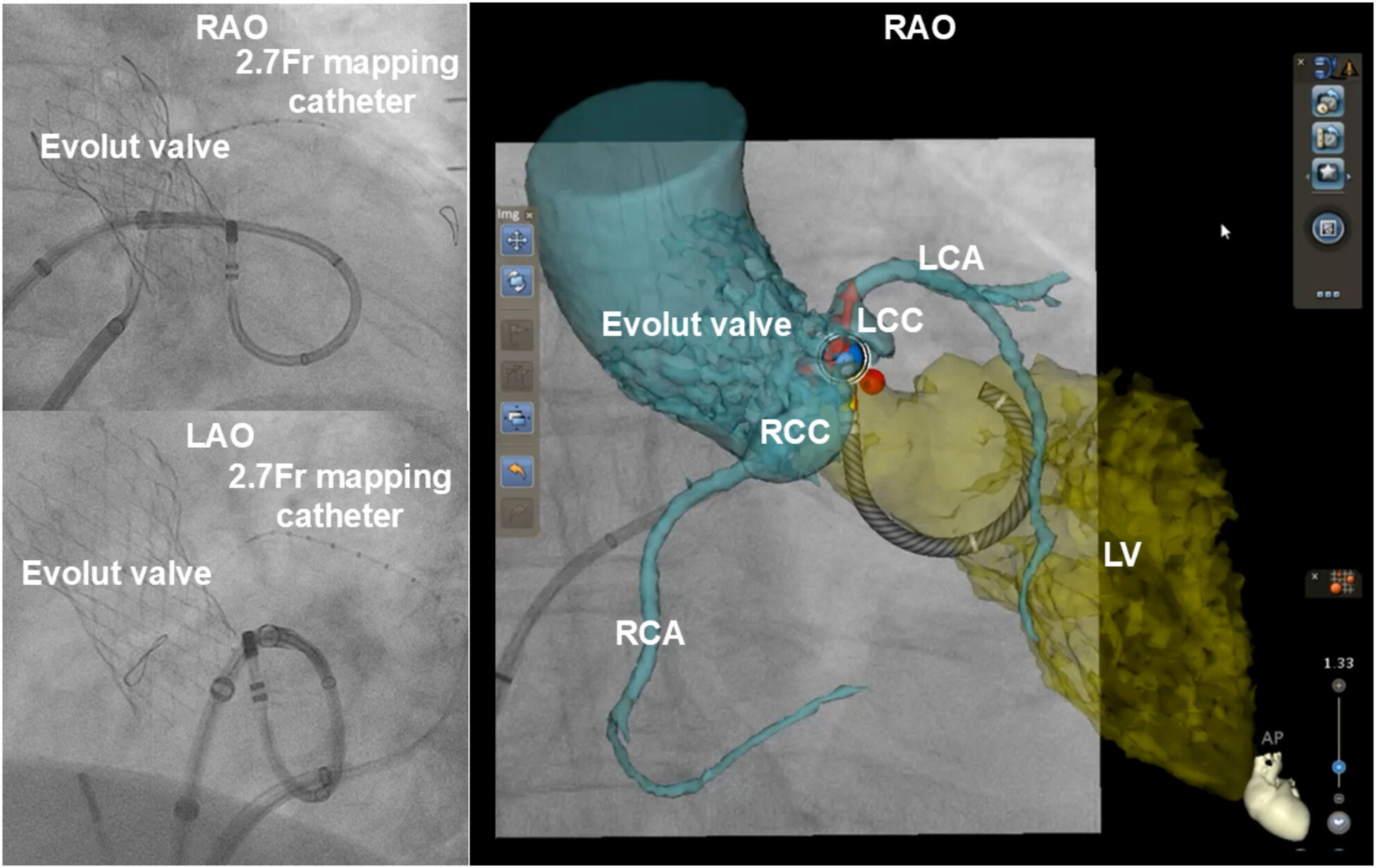 Successful radiofrequency ablation via transseptal approach for premature ventricular contractions originating from left ventricular outflow tract following self-expanding transcatheter aortic valve implantation