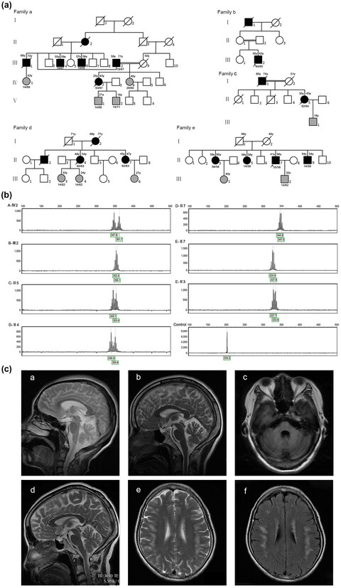 Clinical features and genetic characteristics of homozygous spinocerebellar ataxia type 3