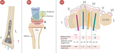 Optimal screw length in volar locking plate osteosynthesis for distal radius fractures: a systematic review