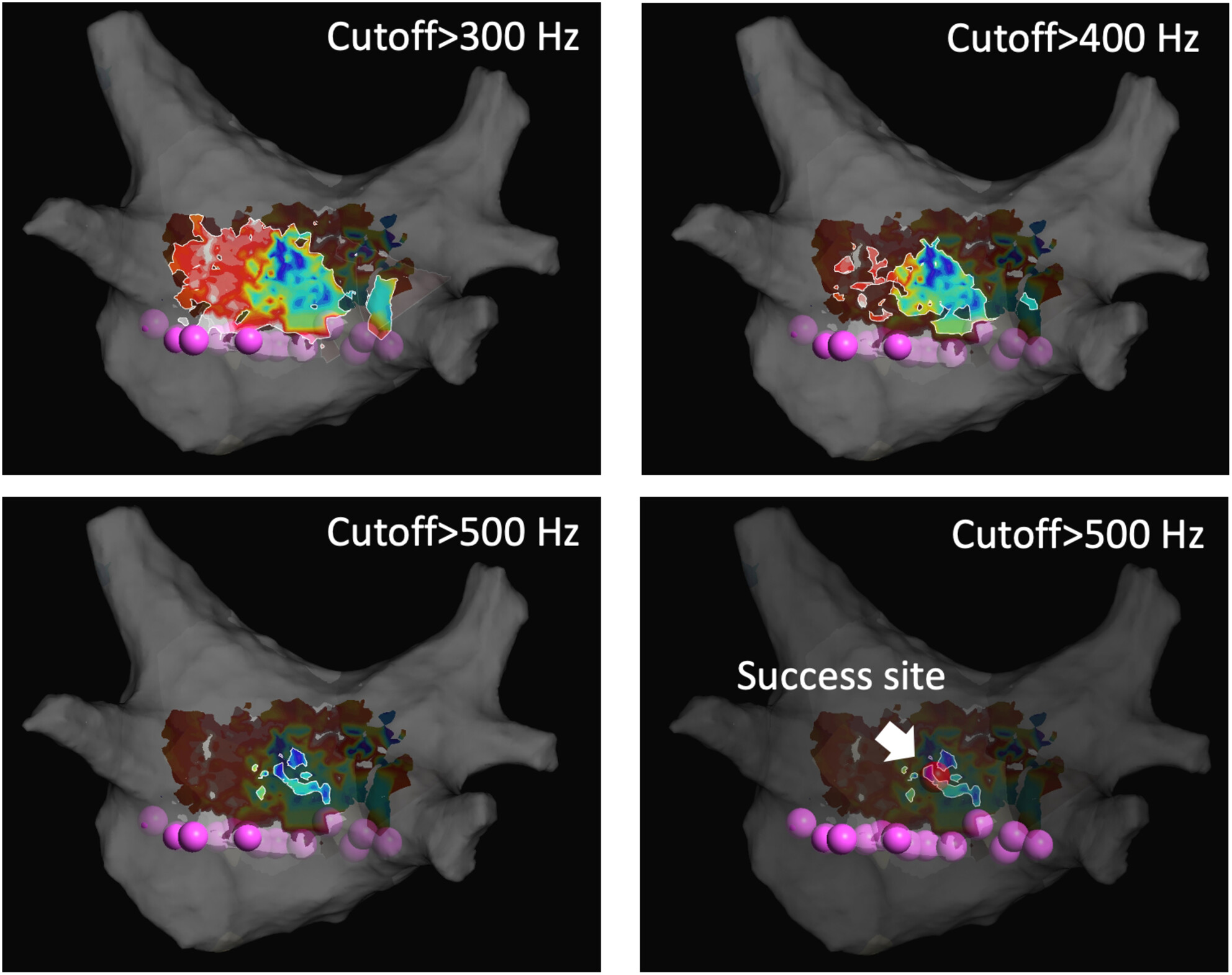 Usefulness of peak frequency in Electrograms for elimination of left atrial Posterior Wall residual potentials via Epicardial connections