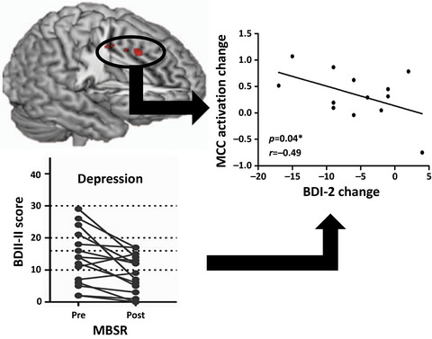 The neural correlates of mindfulness-induced depression reduction in adults with autism spectrum disorder: A pilot study