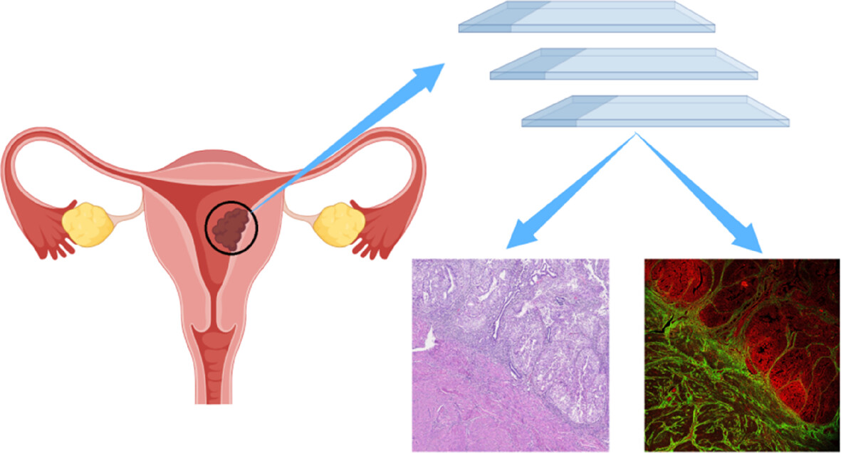 Label-free imaging diagnosis and collagen-optical evaluation of endometrioid adenocarcinoma with multiphoton microscopy