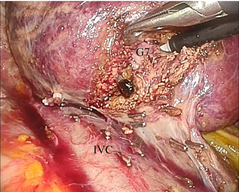Laparoscopic anatomic resection of segment 7 of the liver using the intrahepatic Glissonean approach from the dorsal side (with video)
