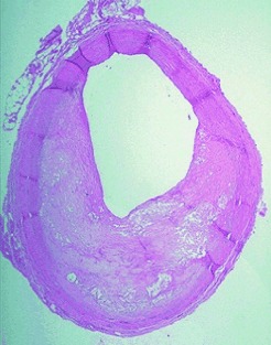 Ozone in Arteriosclerotic Plaques: Searching for the “Smoking Gun”