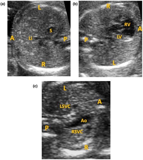 A novel DNAH11 variant segregating in a sibship with heterotaxy and implications for genetic counseling