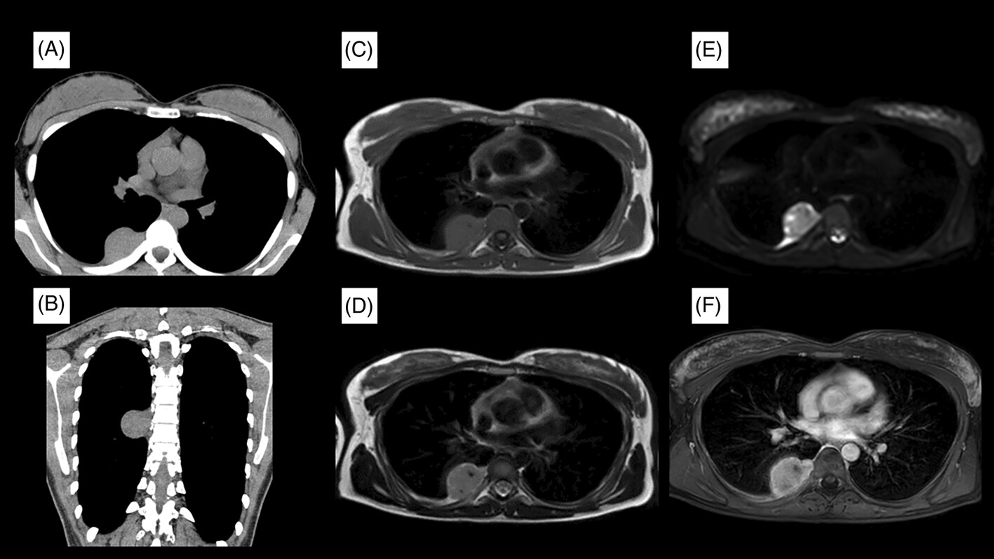 Unicentric Castleman's Disease of Paraspinal Origin Requiring Differentiation From Schwannoma: Case Report