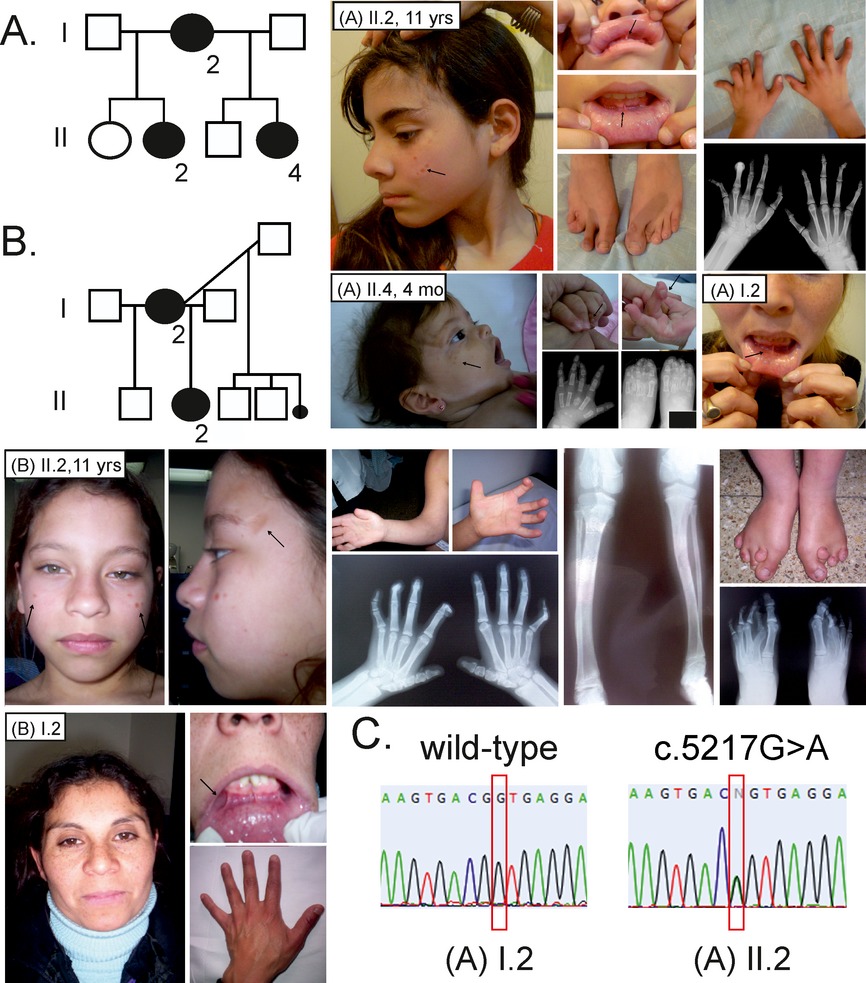 Terminal osseous dysplasia with pigmentary defects (TODPD) due to a recurrent filamin A (FLNA) mutation
