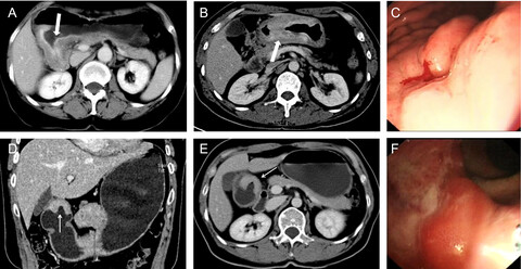 Differences in clinicopathological characteristics and computed tomography findings between signet ring cell carcinoma and nonsignet ring cell carcinoma in early and advanced gastric cancer