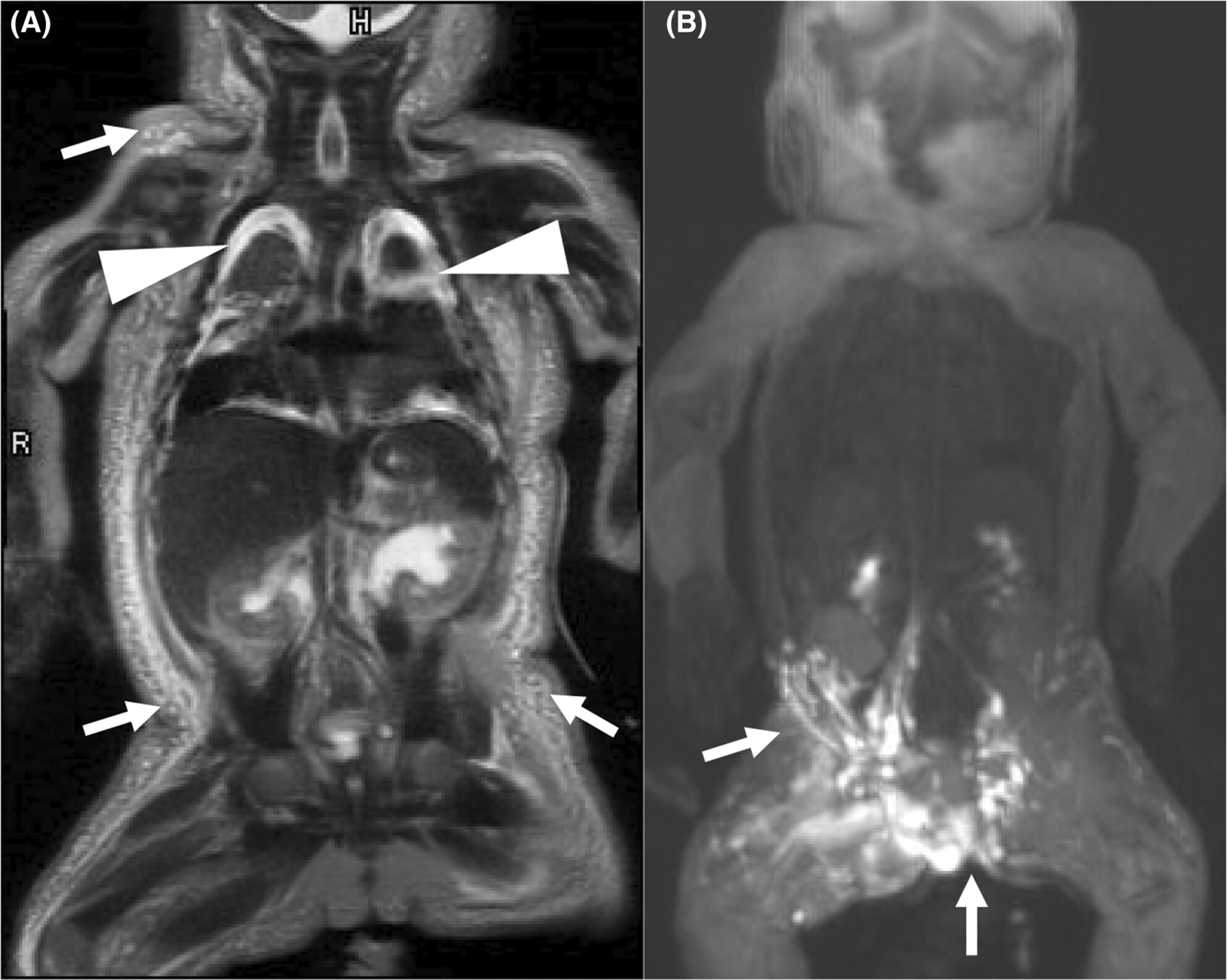 Trametinib restores the central conducting lymphatic flow in a premature infant with Noonan syndrome