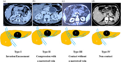 Application of a preoperative image scoring system in laparoscopic spleen-preserving distal pancreatectomy