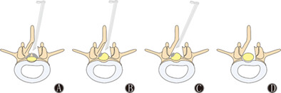 Percutaneous Endoscopic Unilateral Laminotomy and Bilateral Decompression for Lumbar Spinal Stenosis