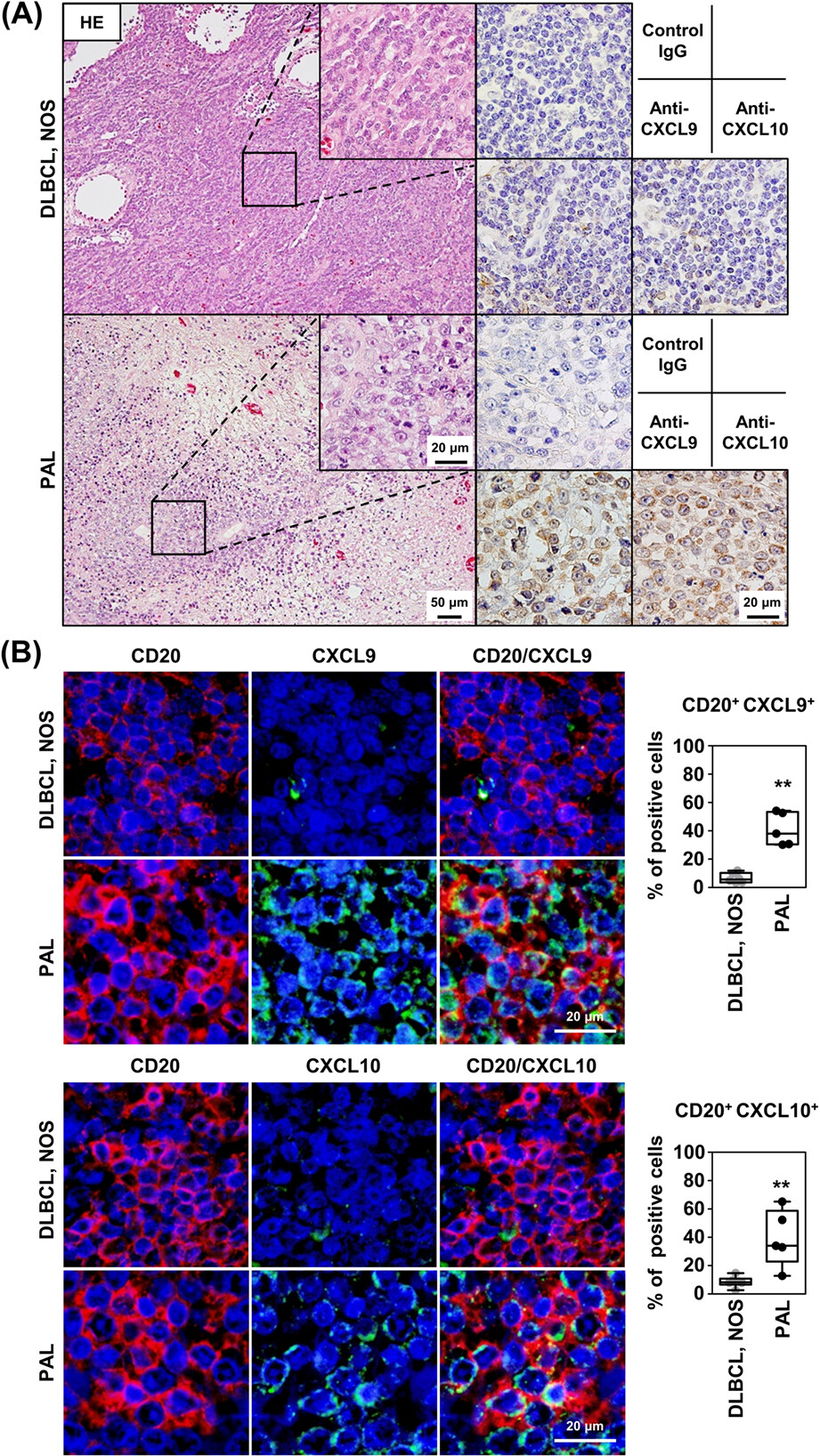 EBV-positive pyothorax-associated lymphoma expresses CXCL9 and CXCL10 chemokines that attract cytotoxic lymphocytes via CXCR3