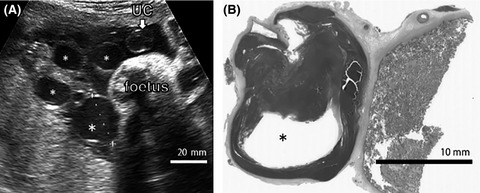 Anemia in a neonate with placental mesenchymal dysplasia
