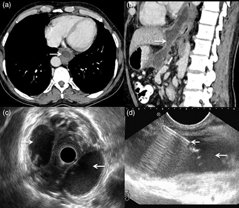 Thoracic complications of pancreatitis