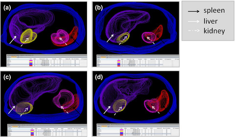 Immunosuppression and cardiovascular dysfunction in patients with severe versus mild coronavirus disease 2019: a case series