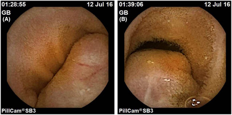 An unusual case of multiple gastrointestinal stromal tumors in the small bowel presenting as occult and overt gastrointestinal bleeding