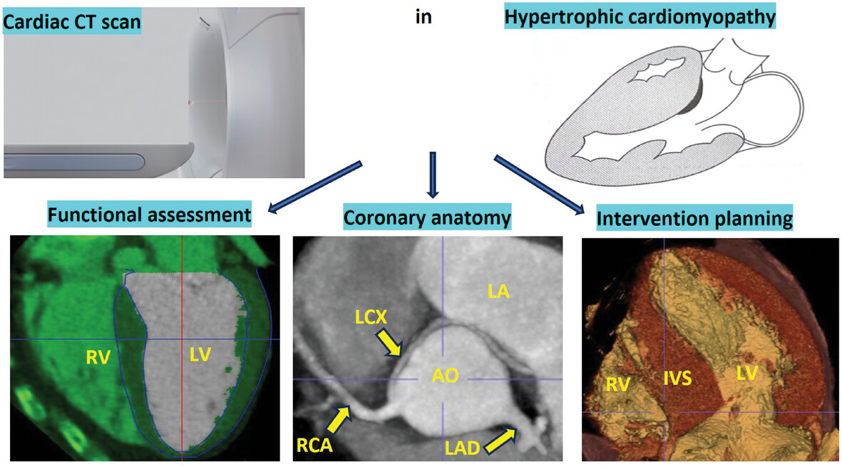 Value of Advanced Cardiac CTA in Clinical Assessment of Hypertrophic Cardiomyopathy: A Literature Review and Practical Implications
