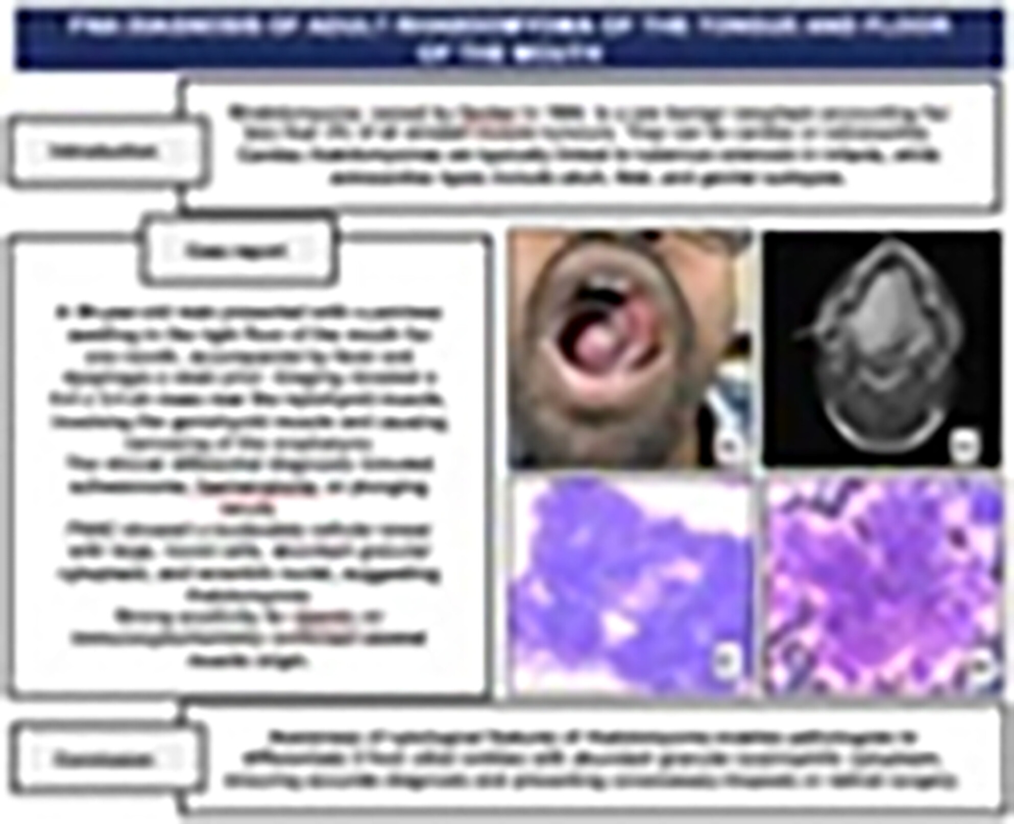 FNA Diagnosis of Adult Rhabdomyoma of the Tongue and Floor of the Mouth