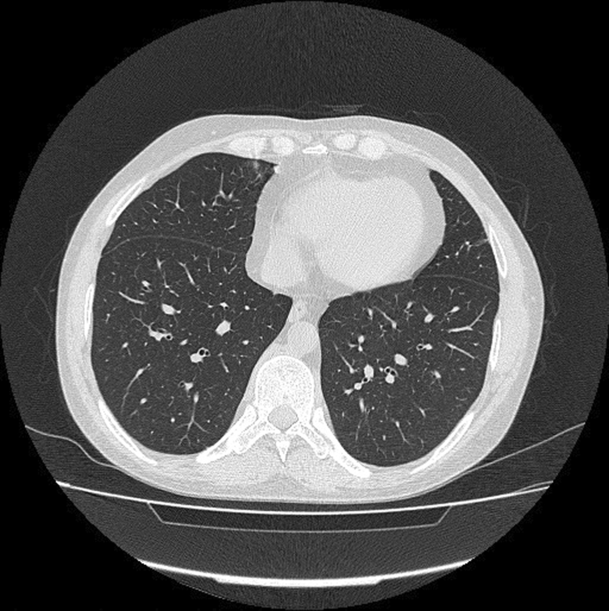 Sarcoidosis with multiple organ involvement and uncommon symptoms: A case report