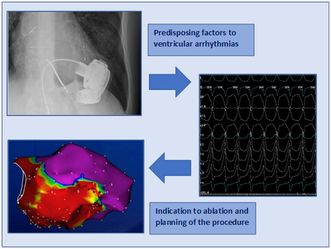 Ablation therapy for ventricular arrhythmias in patients with LVAD: Multiple faces of an electrophysiological challenge