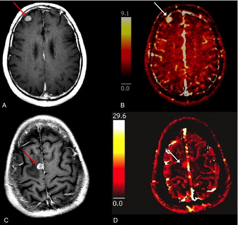 Dynamic contrast-enhanced MRI perfusion for differentiating between melanoma and lung cancer brain metastases