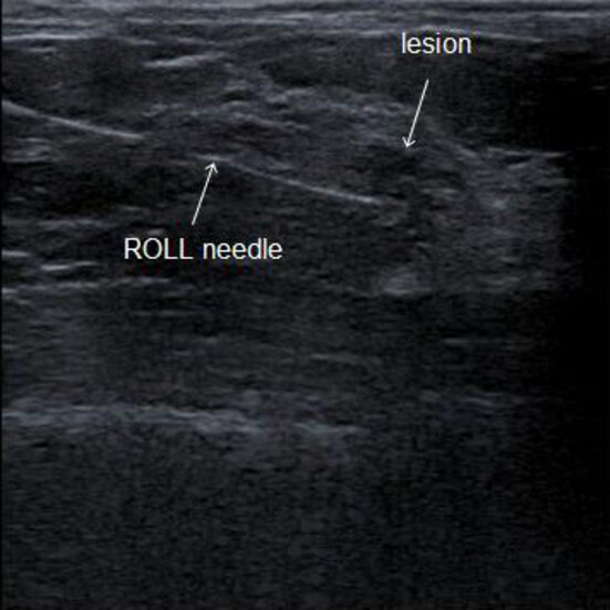 Radioguided localisation of impalpable breast lesions using 99m-Technetium macroaggregated albumin: Lessons learnt during introduction of a new technique to guide preoperative localisation