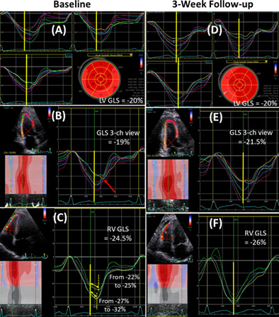 Right ventricular postsystolic shortening: Resolution after opening a totally occluded right coronary artery