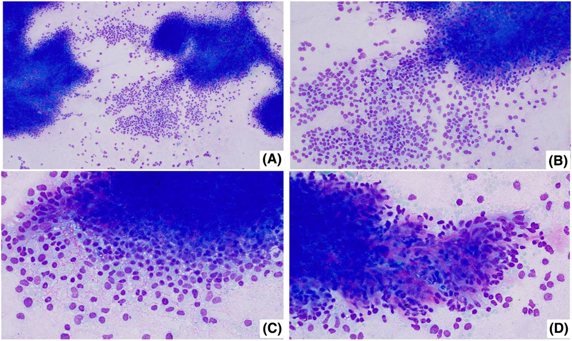 A sub-hepatic nodule in a young female: Chase the case