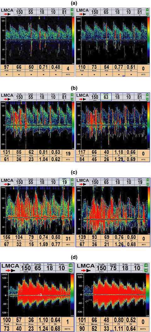Clinical features of right-to-left shunt in the different subgroups of migraine