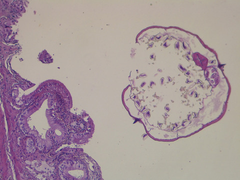 Bile duct infestation with Enterobius vermicularis diagnosed after cholecystectomy: About two case reports