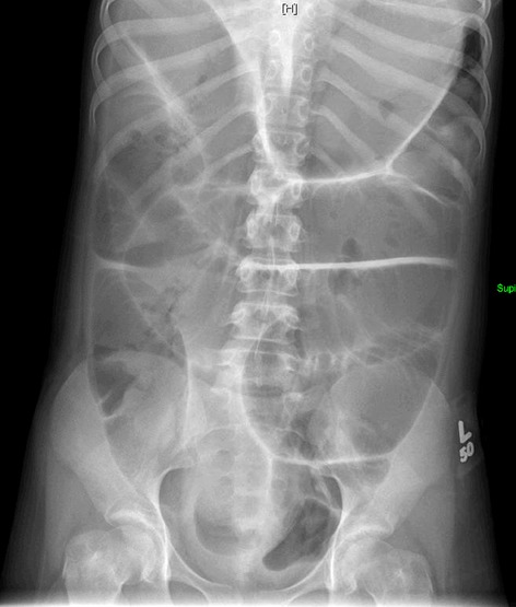 Myotonic dystrophy as a cause of colonic pseudoobstruction: not just another constipated child