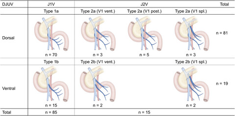 Anatomical Study of the Duodenojejunal Uncinate Process Vein: A Key Landmark for Mesopancreatoduodenal Resection During Pancreaticoduodenectomy