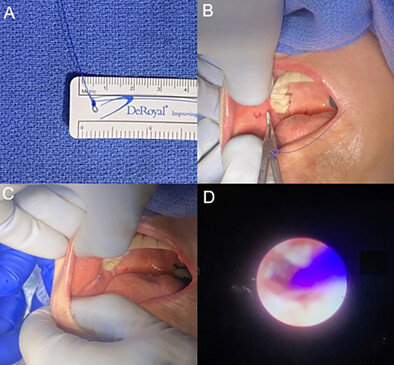 Suture Stenting After Sialendoscopy: A Novel Technique That Reduces Risk of Recurrent Parotitis