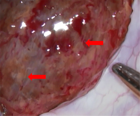 Microdissection testicular sperm extraction in five Japanese patients with non-mosaic Klinefelter's syndrome