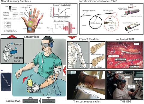 Brain reactions to the use of sensorized hand prosthesis in amputees