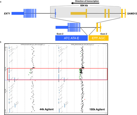 RNA-Seq detects a SAMD12-EXT1 fusion transcript and leads to the discovery of an EXT1 deletion in a child with multiple osteochondromas