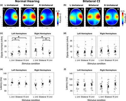 Simultaneous bilateral cochlear implants: Developmental advances do not yet achieve normal cortical processing